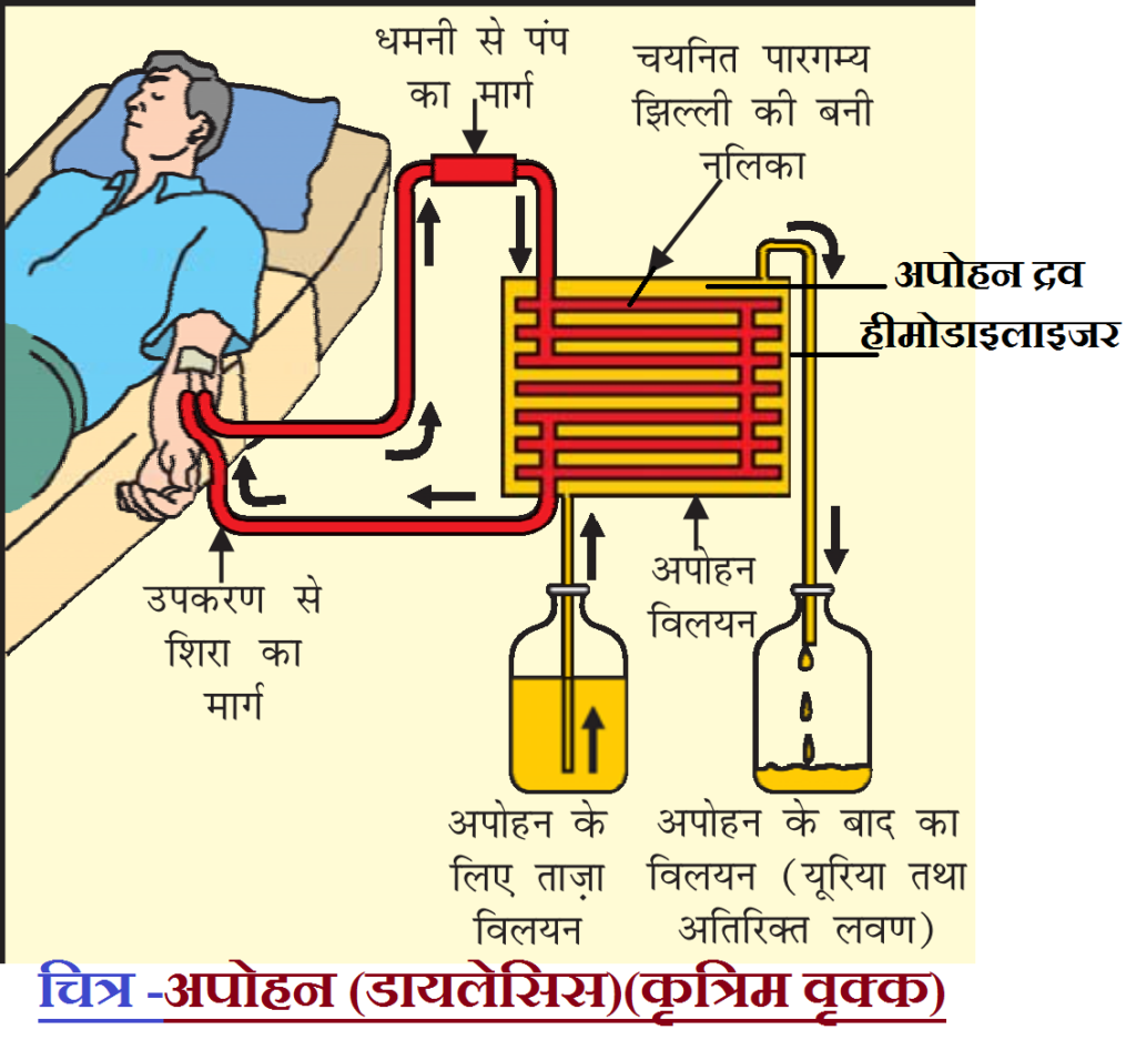 Dialysis or hemodialysis in Human मानव में अपोहन अथवा कृत्रिम वृक्क